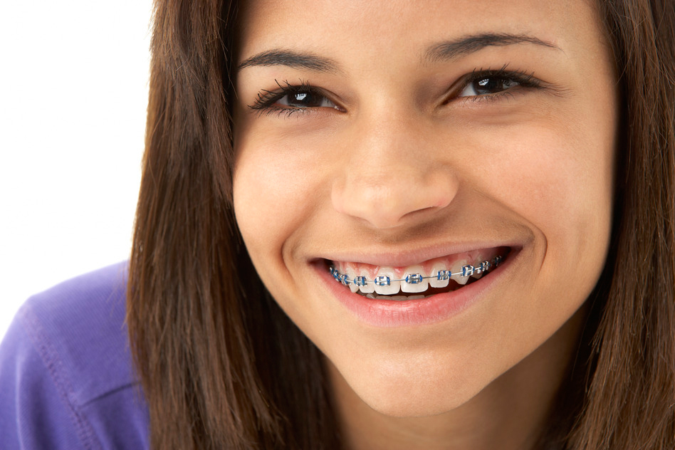 How do you take braces off your teeth at home?
